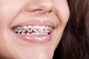 dental-braces-300x200